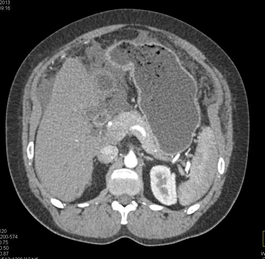 Carcinomatosis with Implants in Abdomen and Pelvis - CTisus CT Scan
