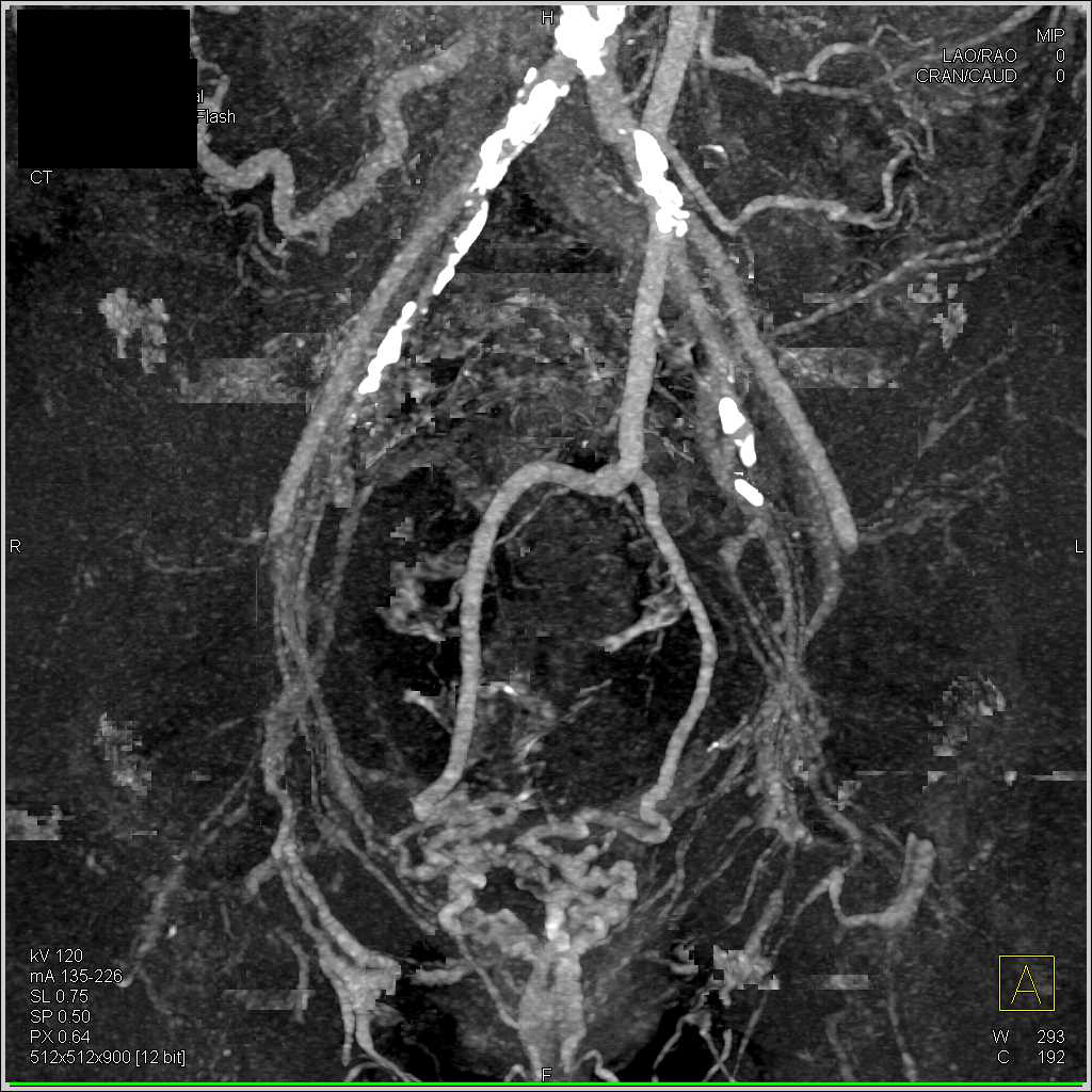 Gastrointestinal (GI) Bleed due to Rectal Varices in a Patient with Portal Hypertension - CTisus CT Scan