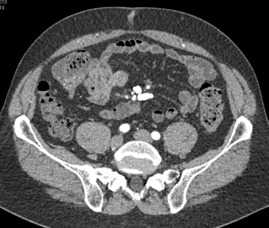 Calcifications in Root of Mesentery - CTisus CT Scan