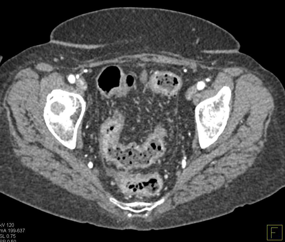 Perforated Gallbladder with a Large Abscess - CTisus CT Scan