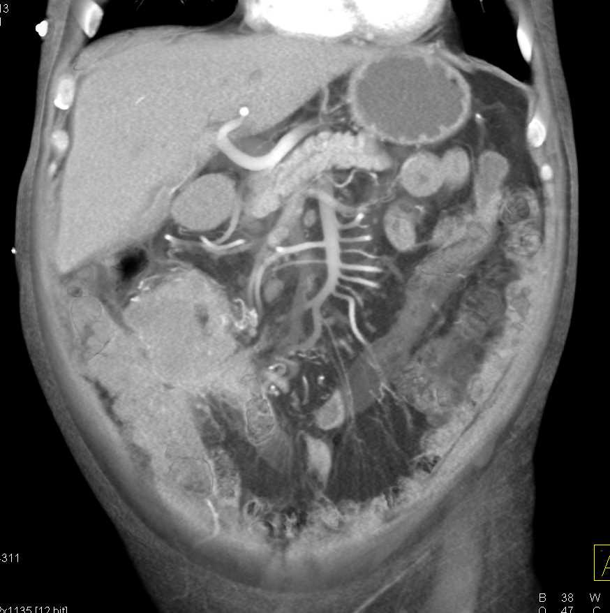 Perforated Colon Cancer - CTisus CT Scan