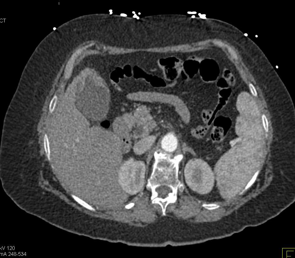 Subtle Gallbladder Cancer on CT and PET/CT - CTisus CT Scan