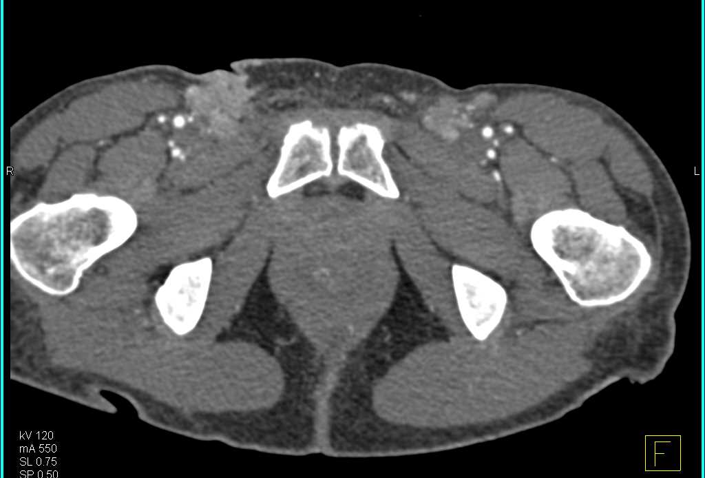 AIDS with Enhancing Inguinal Adenopathy - CTisus CT Scan