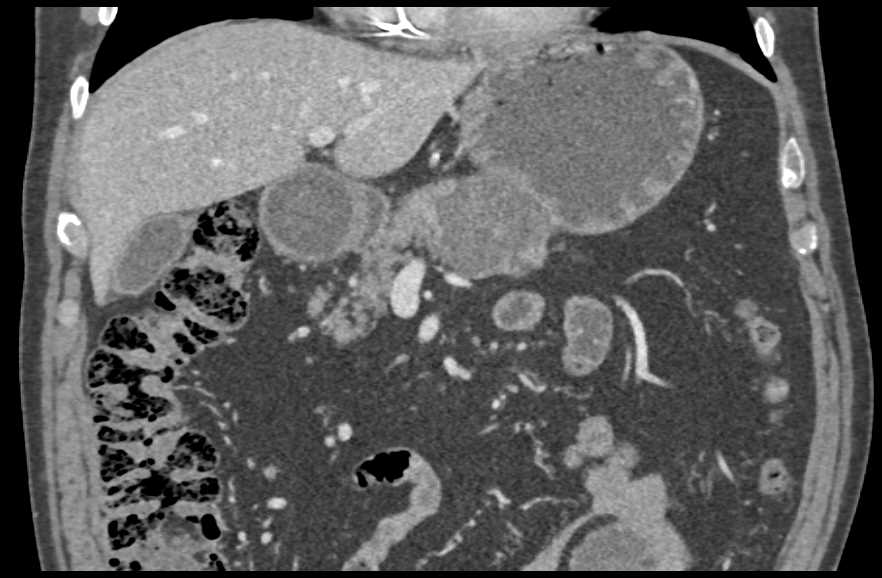 Incidental Small Bowel Lipoma (Jejunum) in Patient with MCN (Mucinous Cystic Neoplasm) Pancreas - CTisus CT Scan