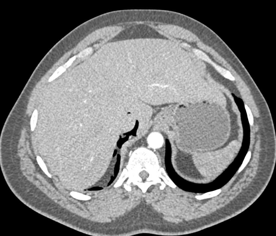 Free Retroperitoneal Air - CTisus CT Scan