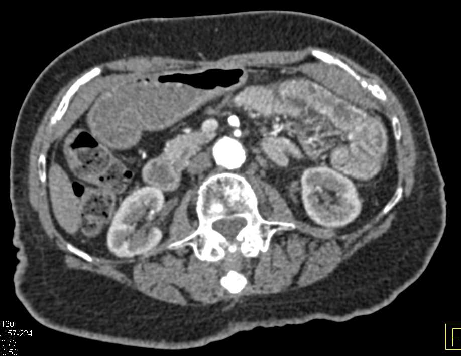Inflamed Jejunal Loops due to Infectious Enteritis - CTisus CT Scan