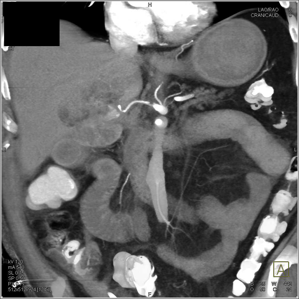 Gastroduodenal Artery (GDA) Pseudoaneurysm Following Whipple Procedure - CTisus CT Scan