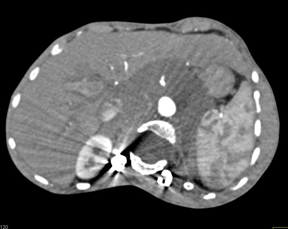 Extensive Neurofibromatosis in the Retroperitoneum - CTisus CT Scan