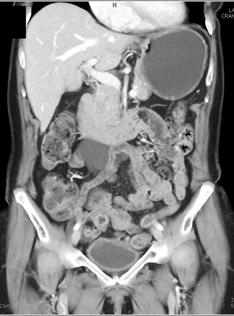 Mesenteric Cyst - CTisus CT Scan