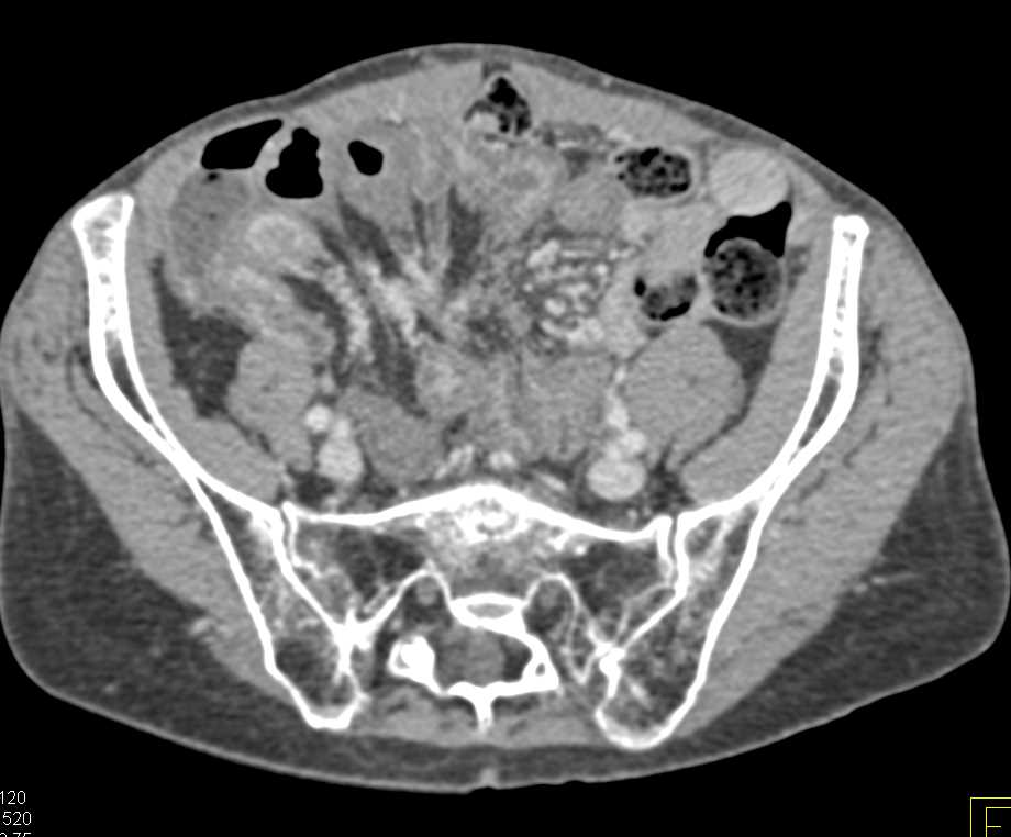 Metastatic Carcinoid Tumor to the Liver and Bowel - CTisus CT Scan