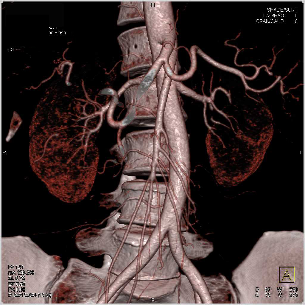 Superior Mesenteric Artery (SMA) Syndrome - CTisus CT Scan