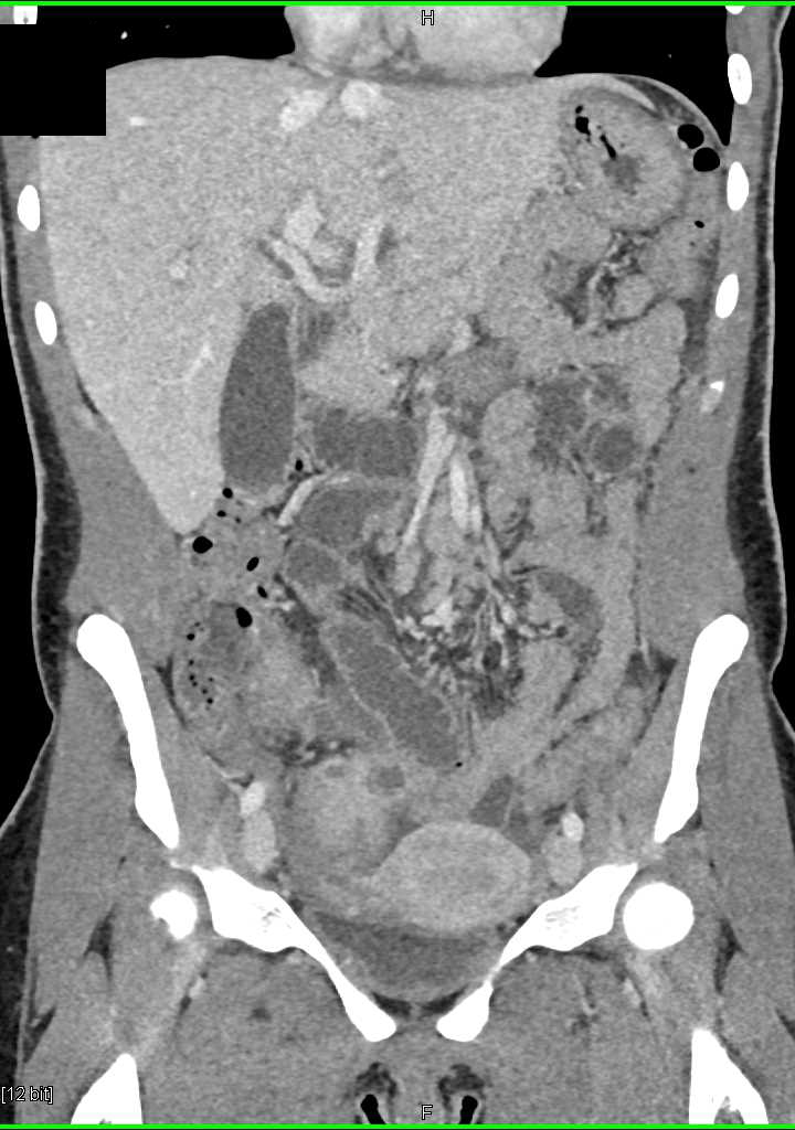 Pelvic Abscess - CTisus CT Scan