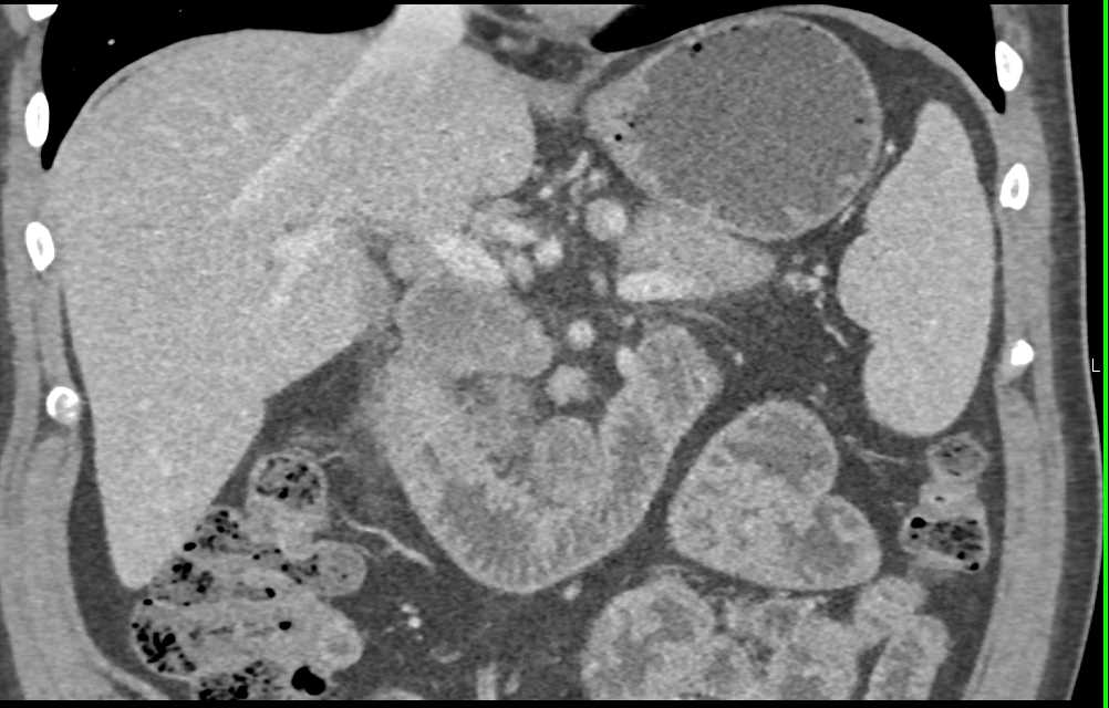 Duodenal Adenocarcinoma Simulates a Pancreatic Adenocarcinoma - CTisus CT Scan
