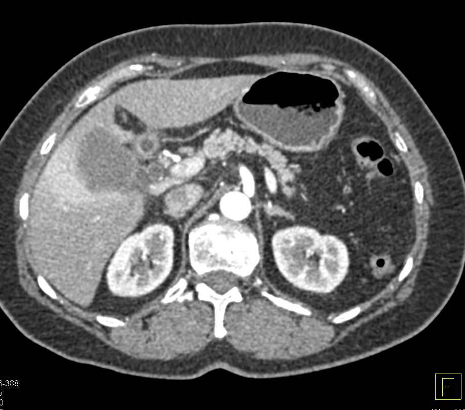 Acute Cholecystitis - CTisus CT Scan