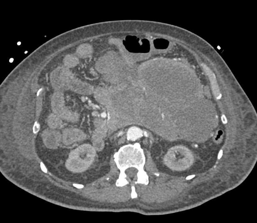 Leiomyosarcoma with Spread of Disease - CTisus CT Scan