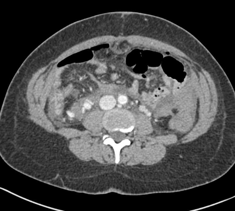 Right Lower Quadrant Active Bleed with Hemoperitoneum - CTisus CT Scan
