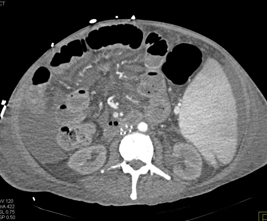 Ascites with Carcinomatosis - CTisus CT Scan