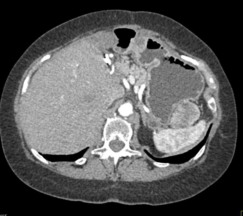 Omental Implants s/p Whipple Procedure - CTisus CT Scan