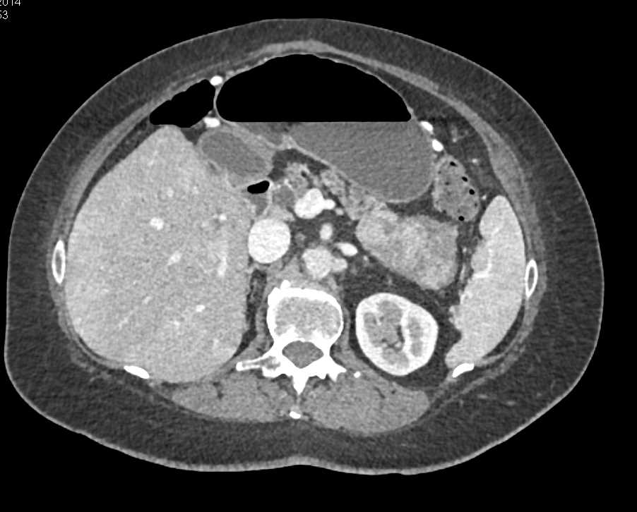 Lymphoma Involves Nodes, Muscle and Tail of the Pancreas - CTisus CT Scan