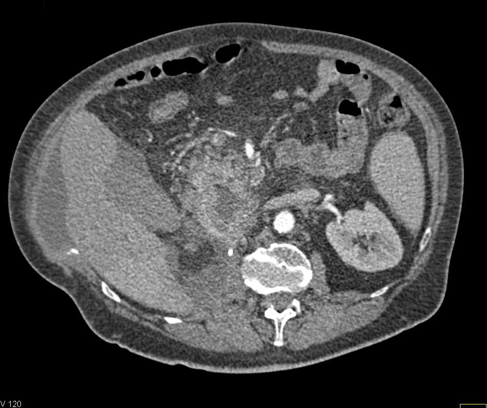 Recurrent Renal Cell Carcinoma with Metastases to the Duodenum - CTisus CT Scan