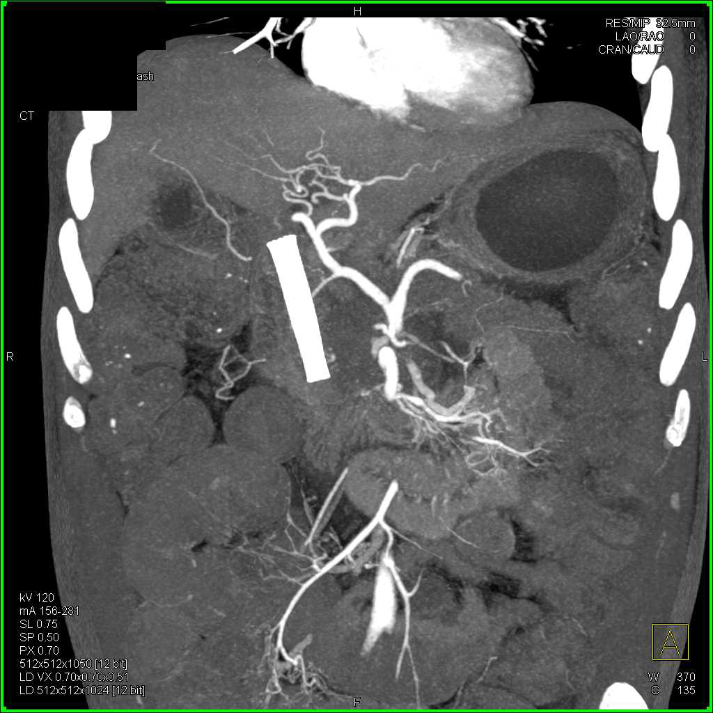 Infiltrating Pancreatic Adenocarcinoma with Arterial and Venous Invasion - CTisus CT Scan