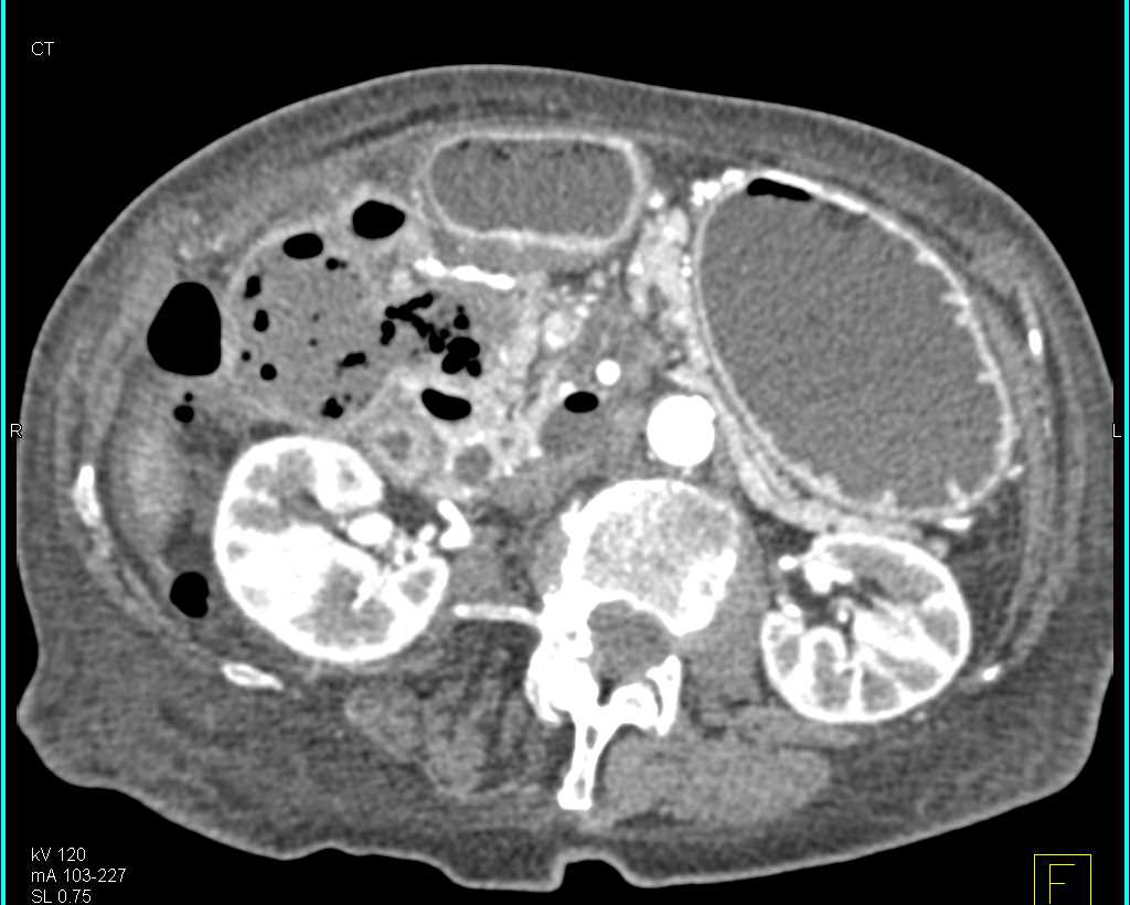 Abscess with Air in the Region of the Gallbladder - CTisus CT Scan