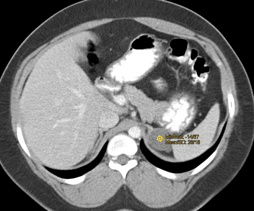Omental Infarct Left Upper Quadrant Following Distal Pancreatectomy and Splenectomy - CTisus CT Scan