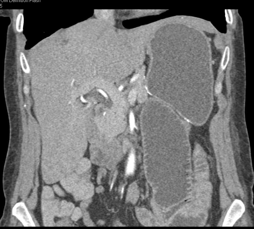 Dilated Small Bowel Loops - CTisus CT Scan