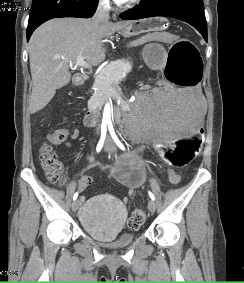 Sarcoma in the Left Upper Quadrant - CTisus CT Scan