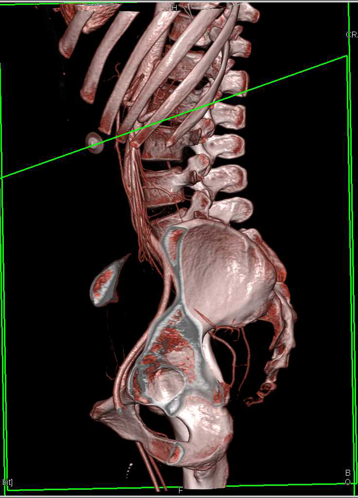 Scaphoid Abdomen and Superior Mesenteric Artery (SMA) Syndrome - CTisus CT Scan