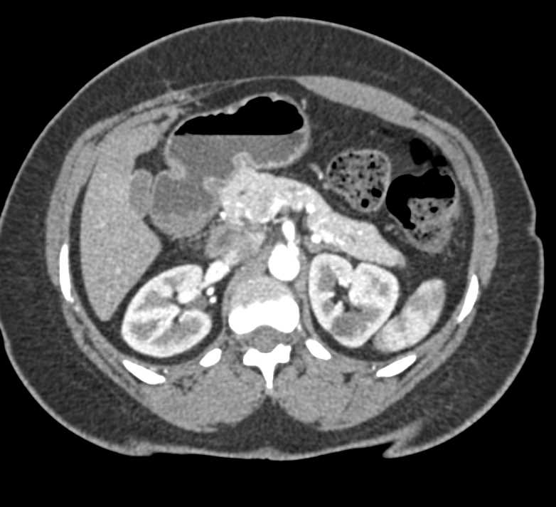Germ Cell Tumor with Para-aortic Adenopathy - CTisus CT Scan