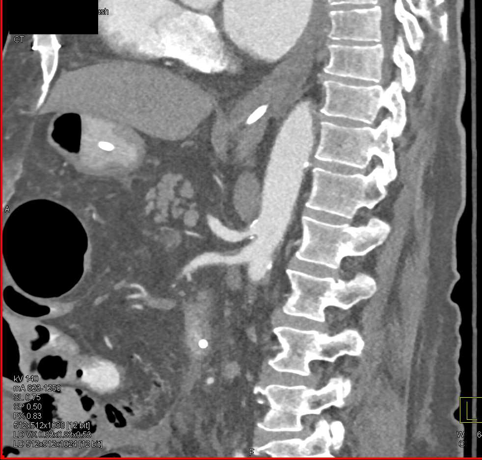 Pneumatosis with Ischemic Bowel - CTisus CT Scan