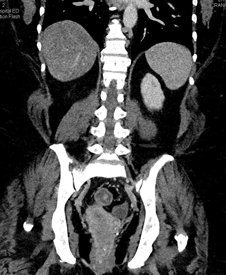 Perianal Disease - CTisus CT Scan
