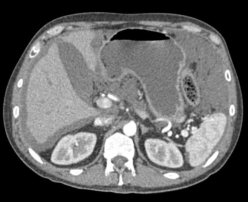 Pseudomyxoma Peritonei (PMP) - CTisus CT Scan