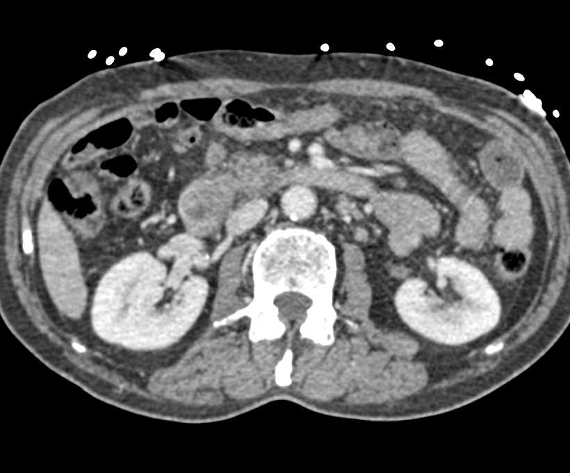 Ampullary Carcinoma - CTisus CT Scan