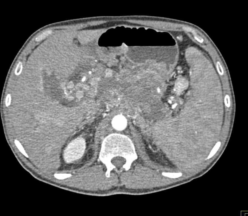 Lymphoma Infiltrates the Pancreas and Mesentery - CTisus CT Scan