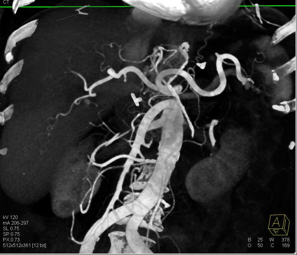 Vessel Encasement and Perfusion Changes Liver - CTisus CT Scan