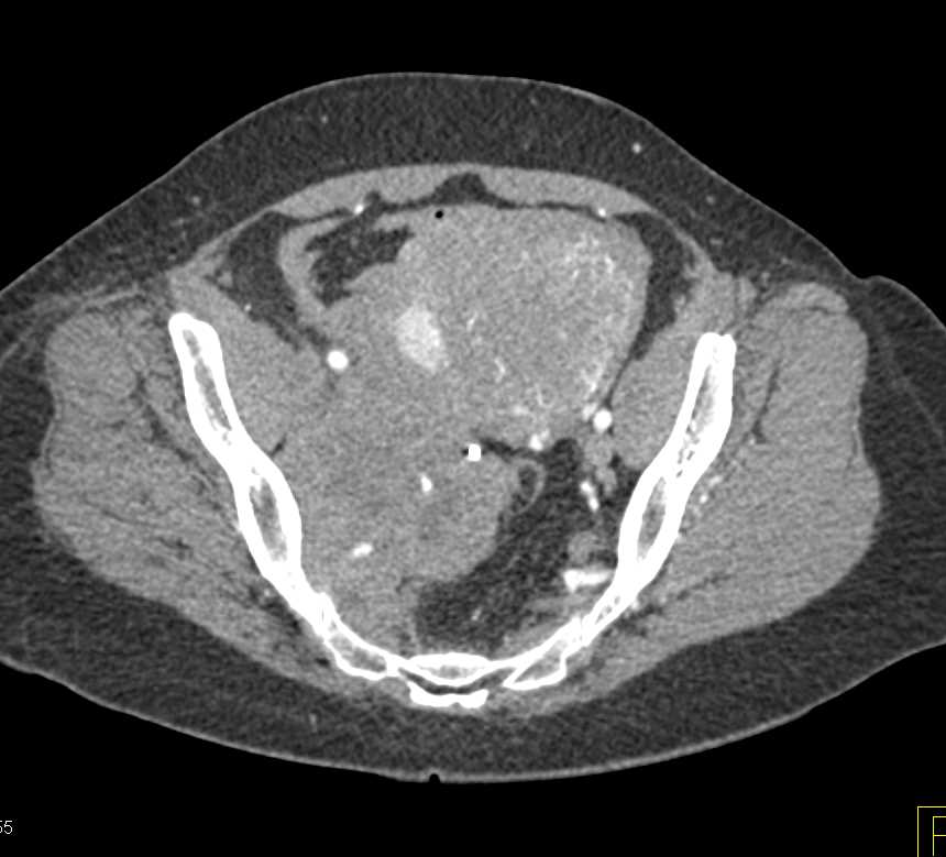 Intraperitoneal Schwannoma - CTisus CT Scan