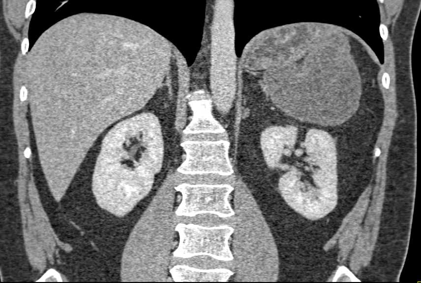 Omental Infarct Left Upper Quadrant S/P Splenectomy and Distal Pancreatectomy - CTisus CT Scan