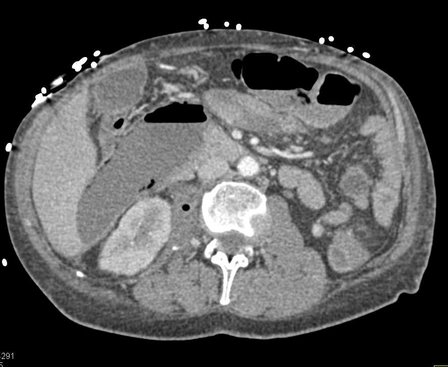 Ischemic Bowel with Pneumatosis - CTisus CT Scan