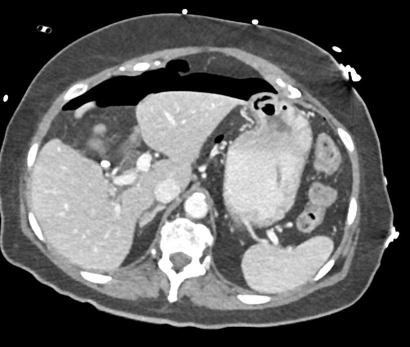 Large Pneumoperitoneum - CTisus CT Scan