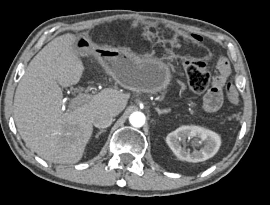 Omental Infarction - CTisus CT Scan