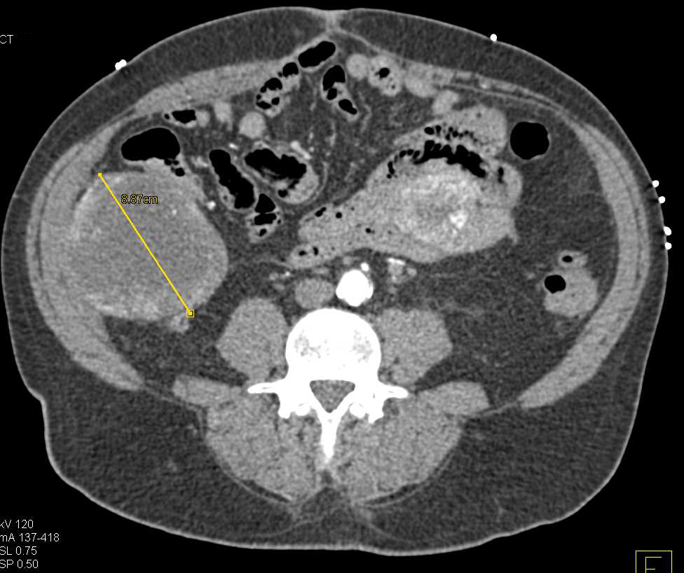 Carcinomatosis with Multiple Implants in the Abdomen and Pelvis - CTisus CT Scan