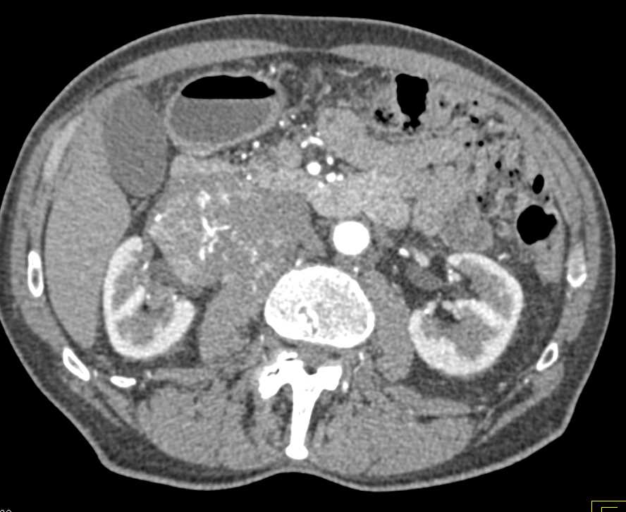Retroperitoneal Sarcoma - CTisus CT Scan
