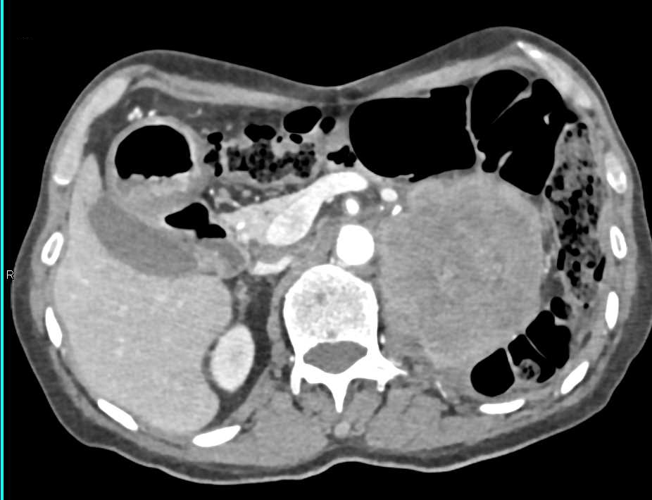 Retroperitoneal Sarcoma Displaces the Left Kidney - CTisus CT Scan