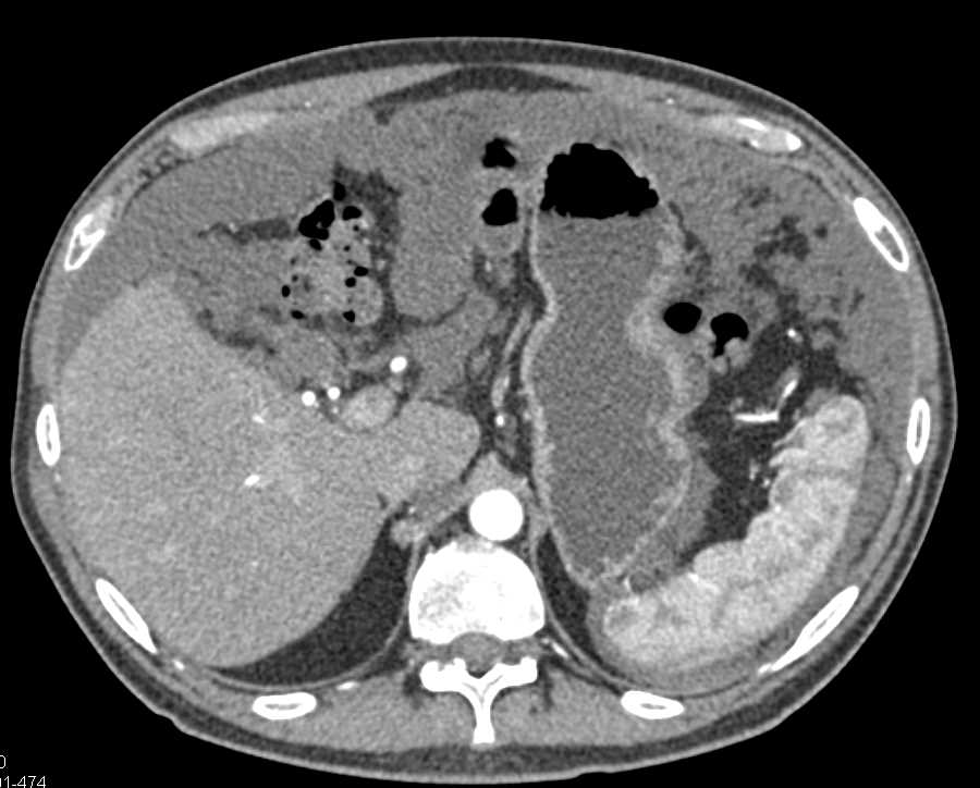 Pseudomyxoma Peritonei (PMP) - CTisus CT Scan