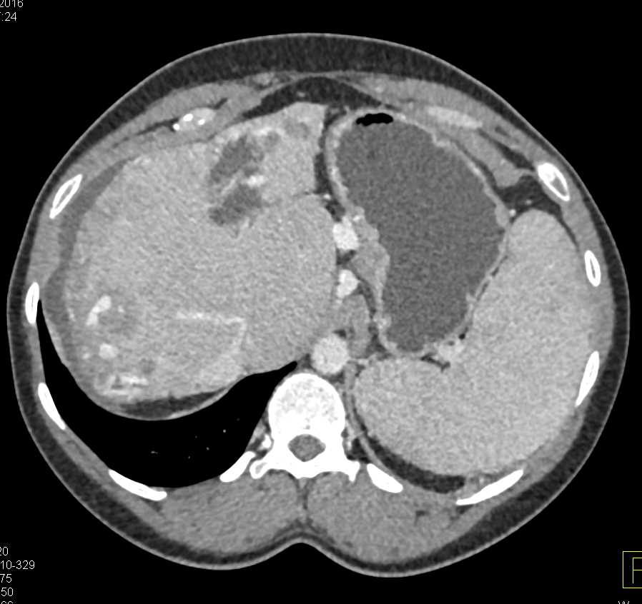 Pseudomyxoma Peritonei (PMP) - CTisus CT Scan