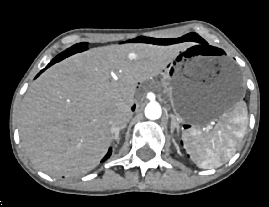 Perforated Ulcer and Pneumoperitoneum - CTisus CT Scan