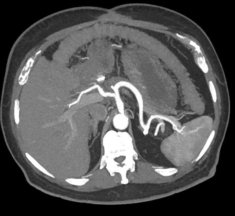 Mesenteric Hematoma in a Patient with Vascular Stents - CTisus CT Scan