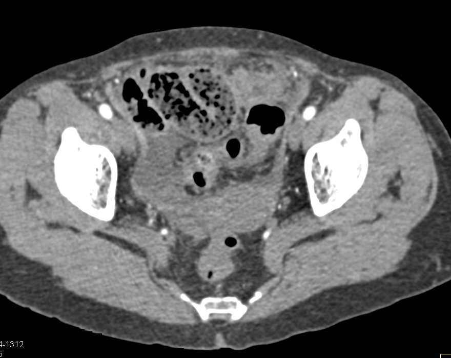 Carcinomatosis - CTisus CT Scan